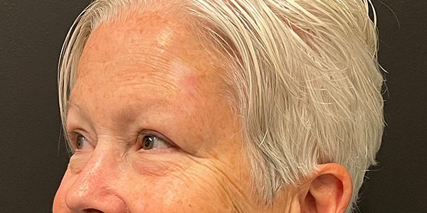 Blepharoplasty Before & After