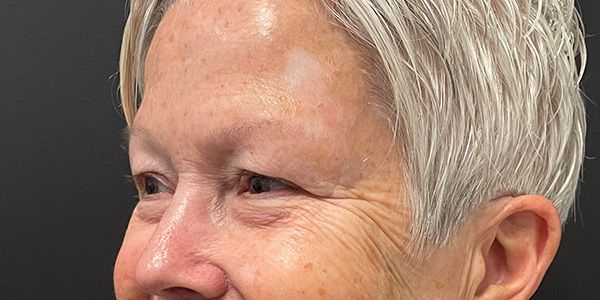 Blepharoplasty Before & After