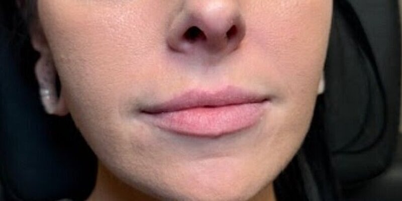 Lips Before & After