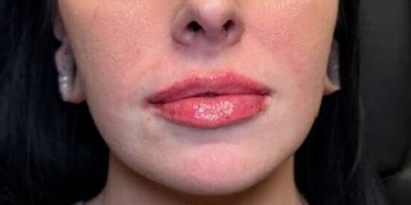 Lips Before & After