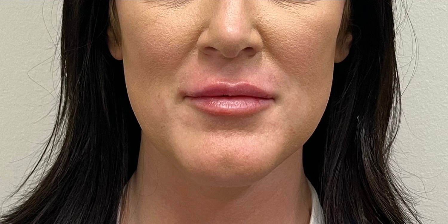 Lips Before & After