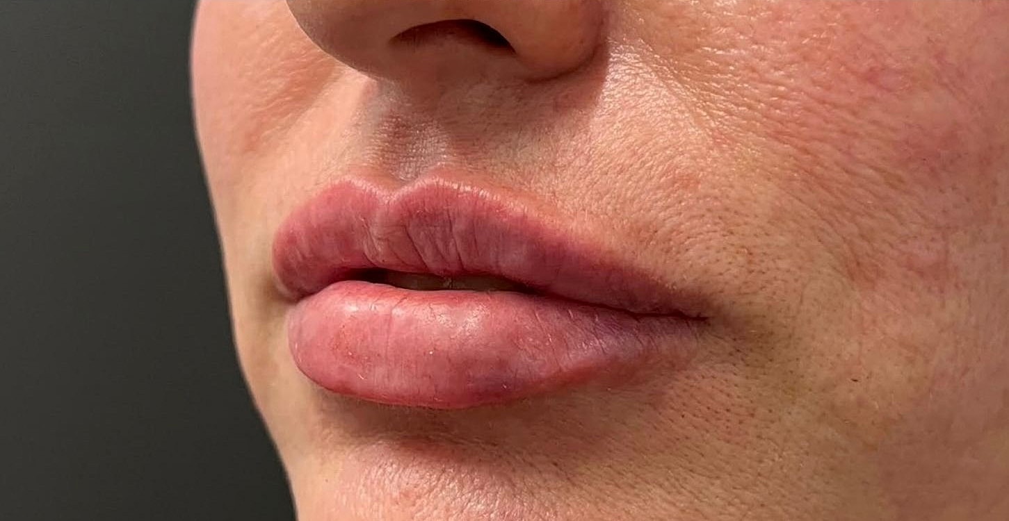 Lips Before & After