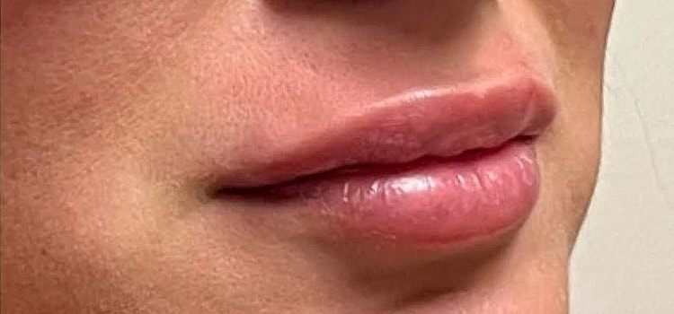 Lips Before & After