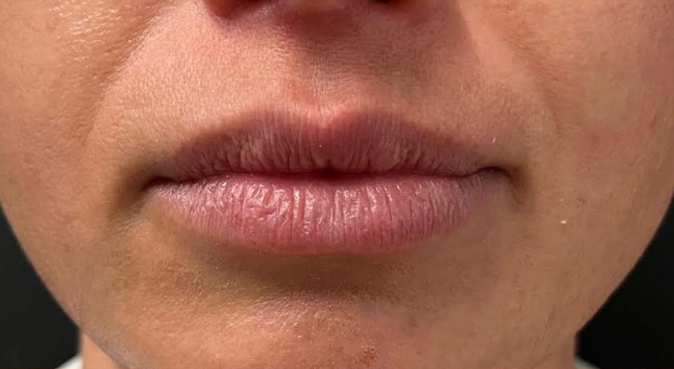 Lips Before & After
