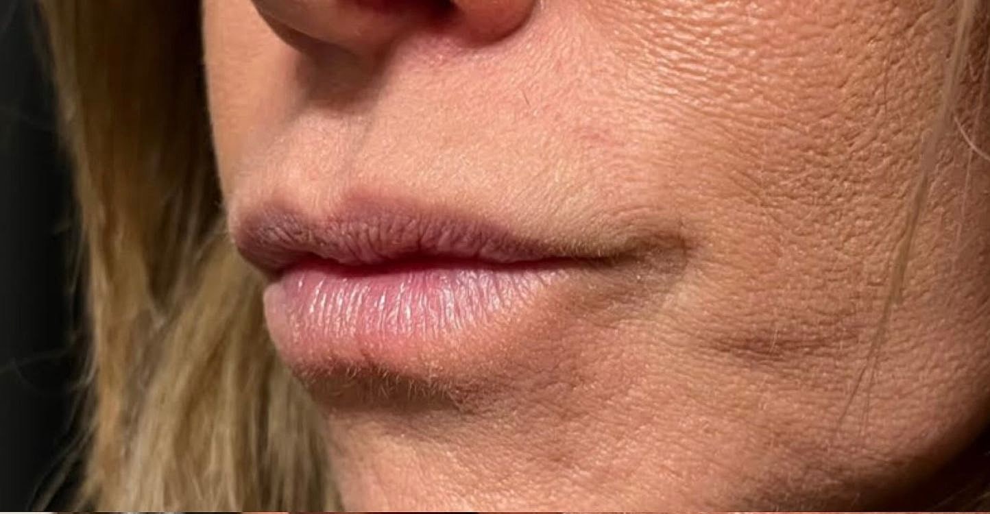 Lips Before & After