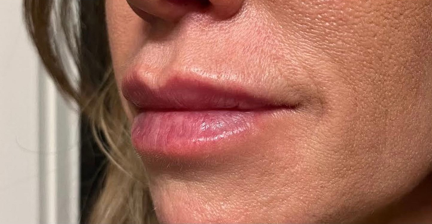 Lips Before & After