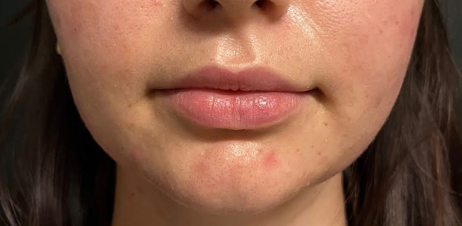 Lips Before & After