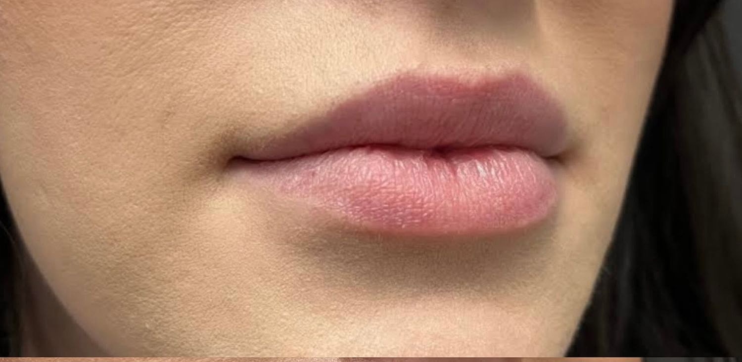 Lips Before & After