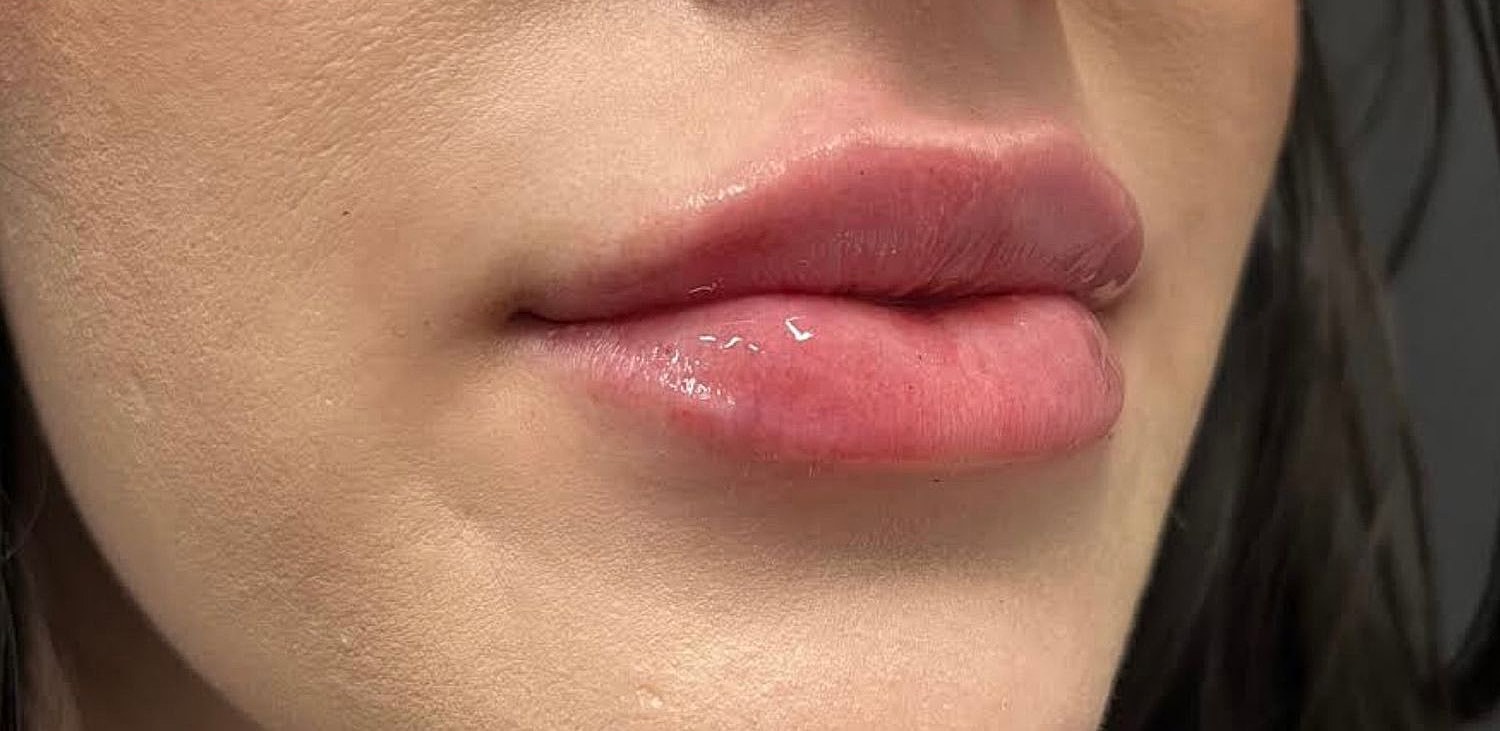 Lips Before & After