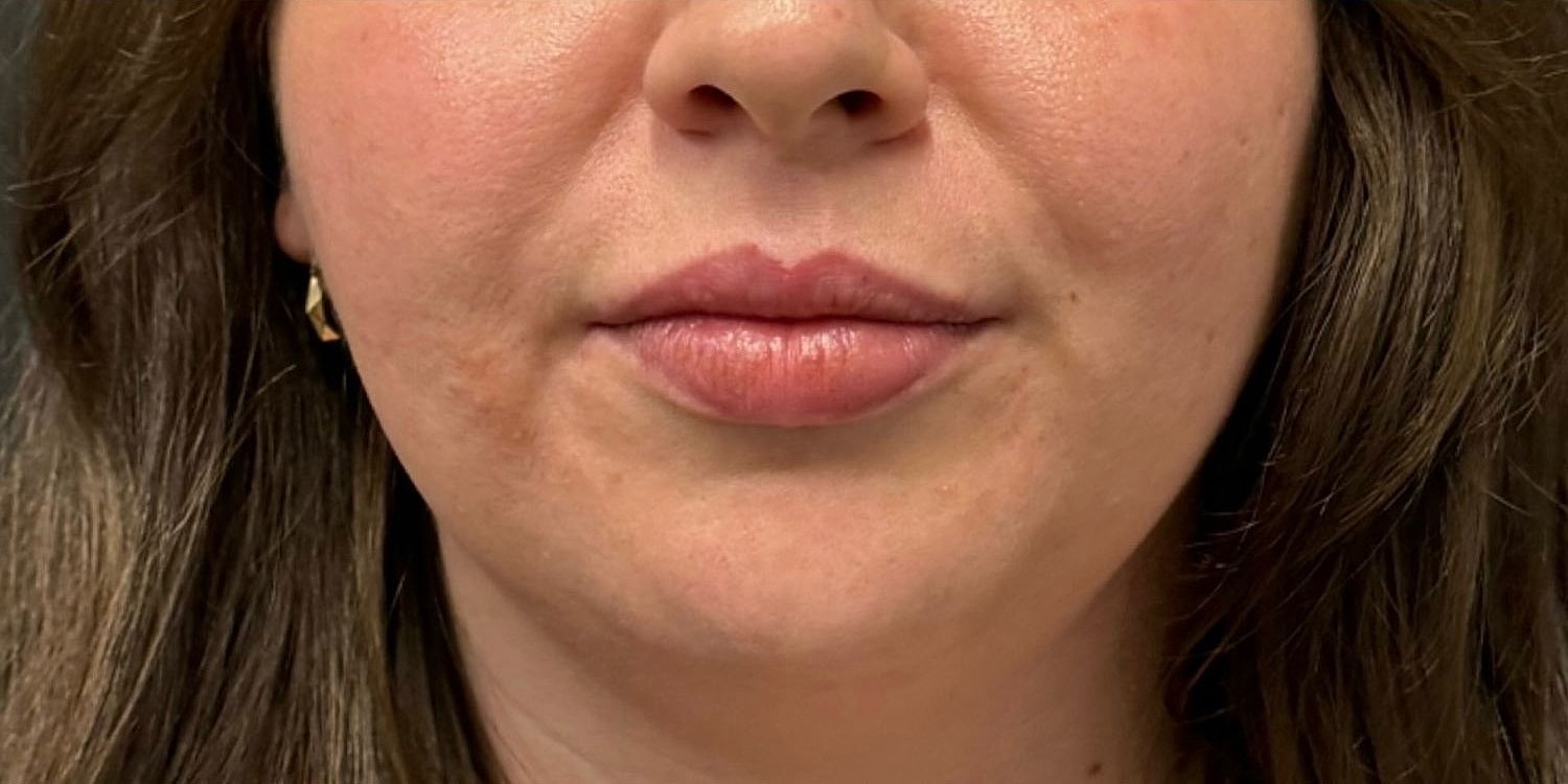 Lips Before & After
