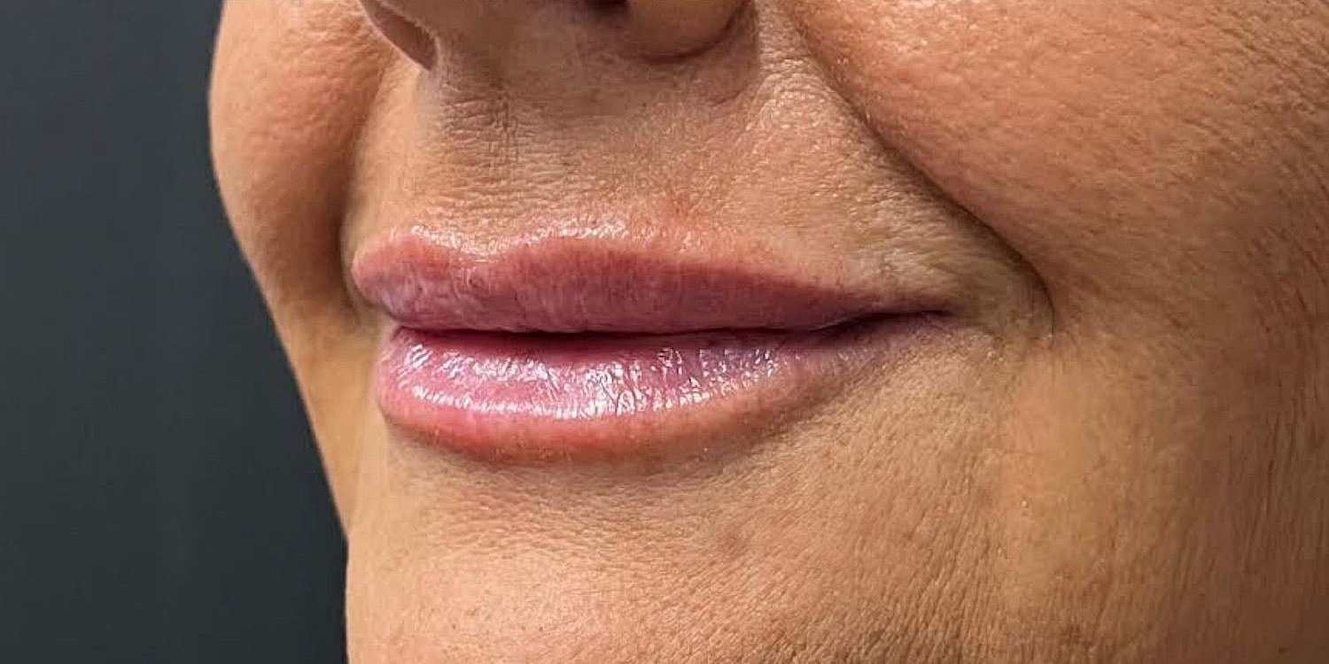 Lips Before & After