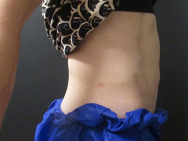 Emsculpt Neo Before & After