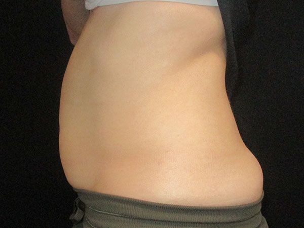 Emsculpt Neo Before & After