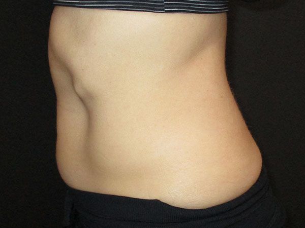 Emsculpt Neo Before & After