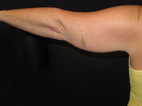 Emsculpt Neo Before & After