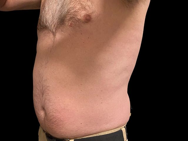 Emsculpt Neo Before & After