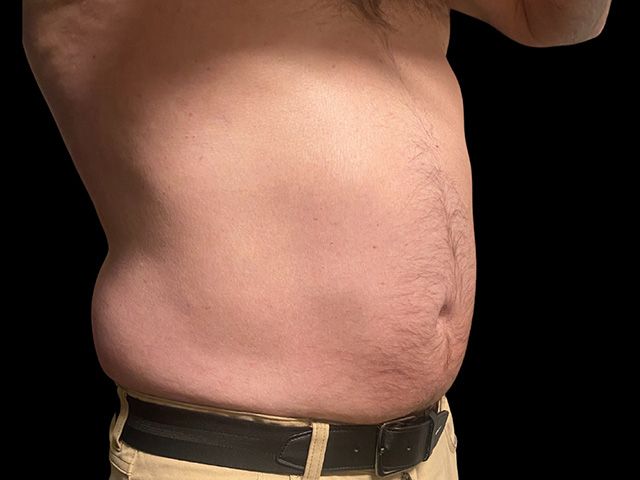 Emsculpt Neo Before & After