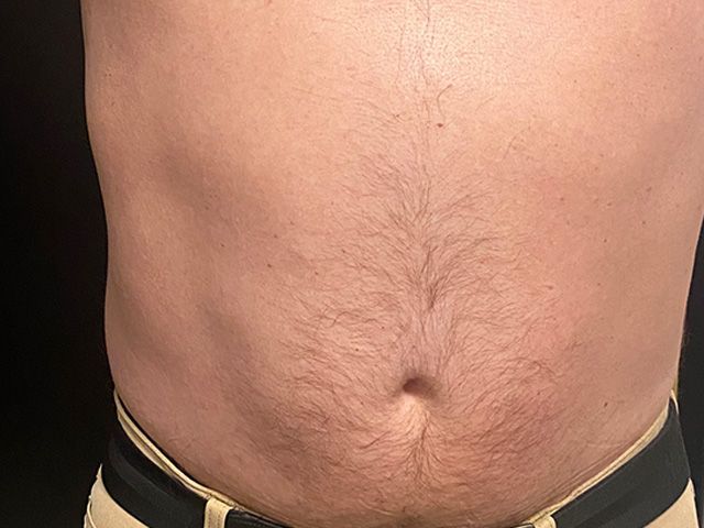 Emsculpt Neo Before & After