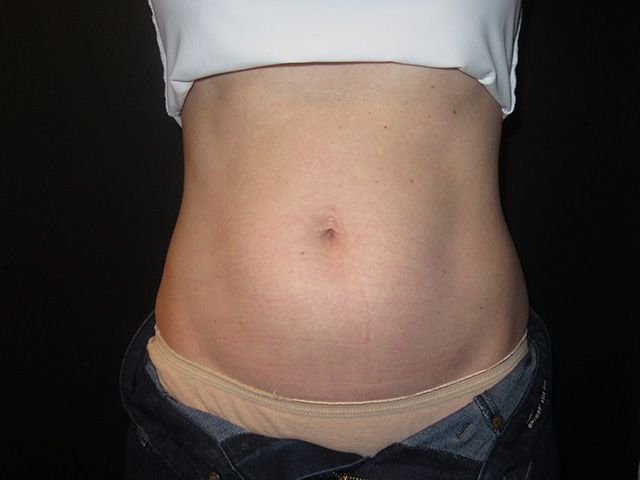 Emsculpt Neo Before & After