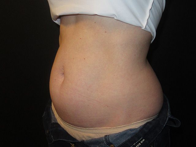 Emsculpt Neo Before & After