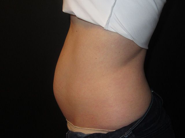 Emsculpt Neo Before & After