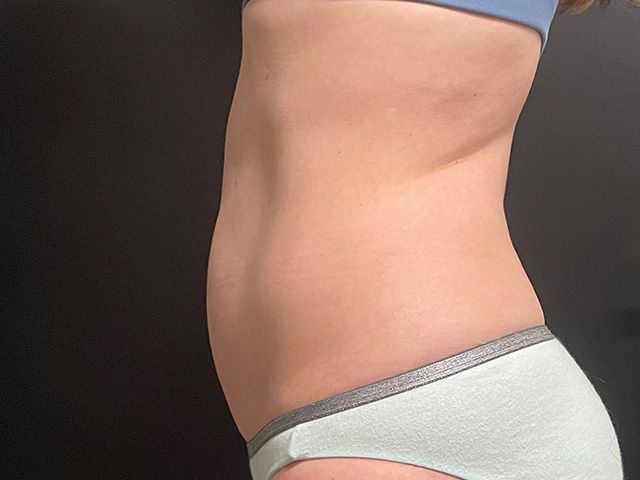 Emsculpt Neo Before & After