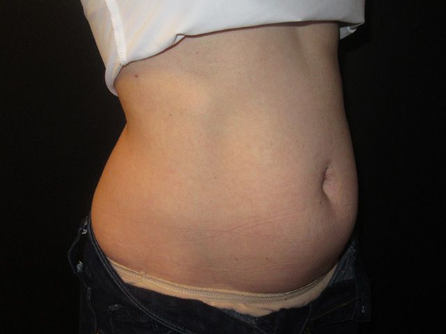 Emsculpt Neo Before & After