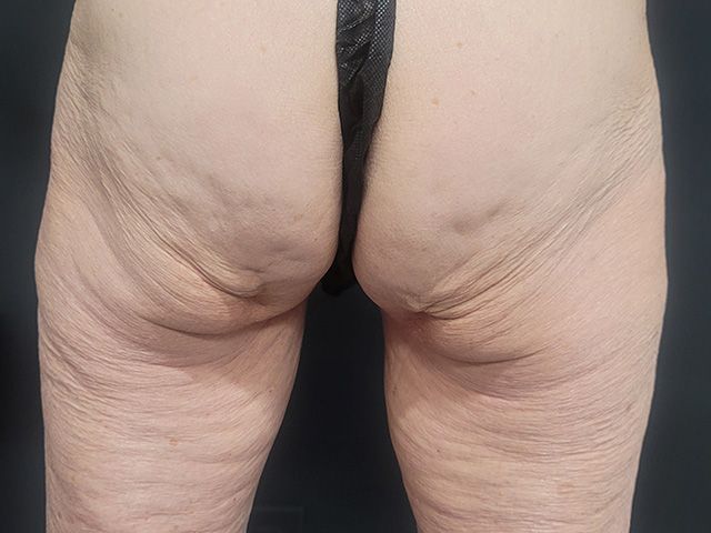 Emsculpt Neo Before & After