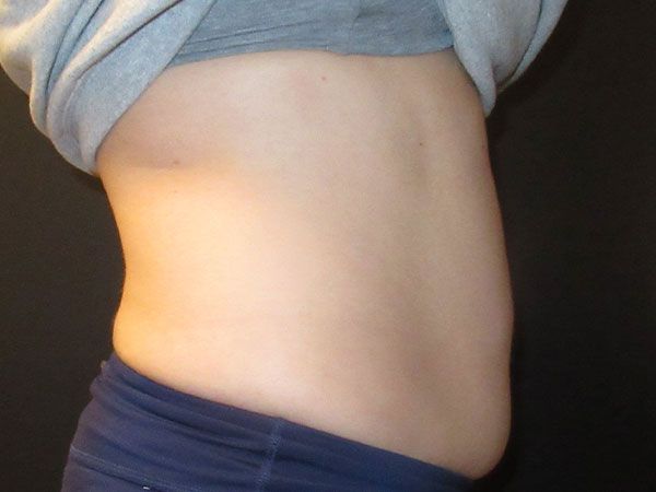 Emsculpt Neo Before & After