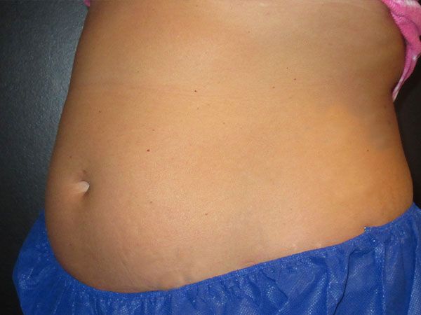 Emsculpt Neo Before & After