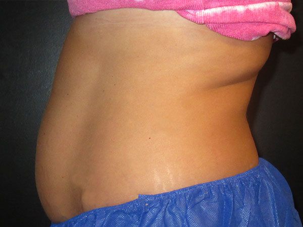 Emsculpt Neo Before & After