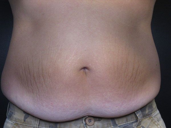 Emsculpt Neo Before & After