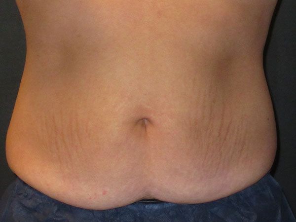 Emsculpt Neo Before & After