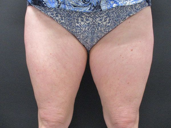 Emsculpt Neo Before & After