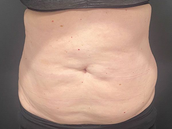 Emsculpt Neo Before & After