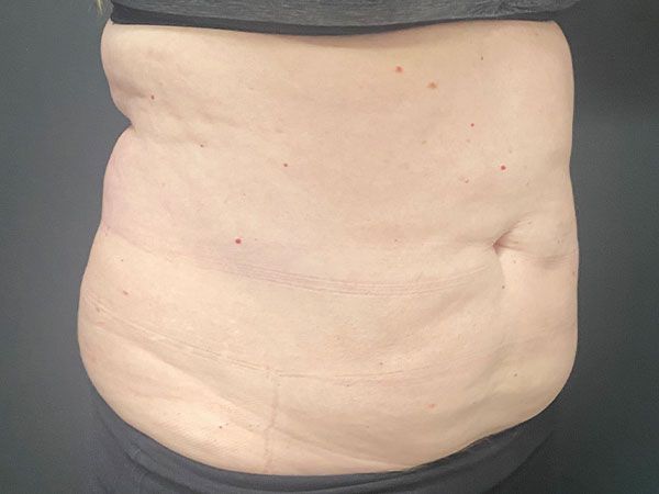 Emsculpt Neo Before & After