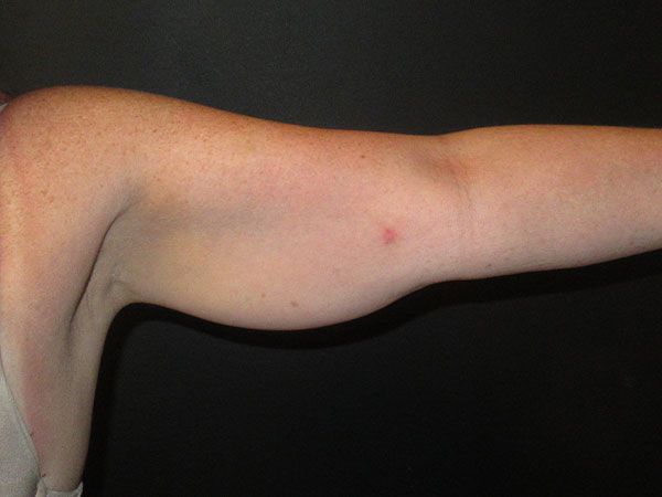 Emsculpt Neo Before & After