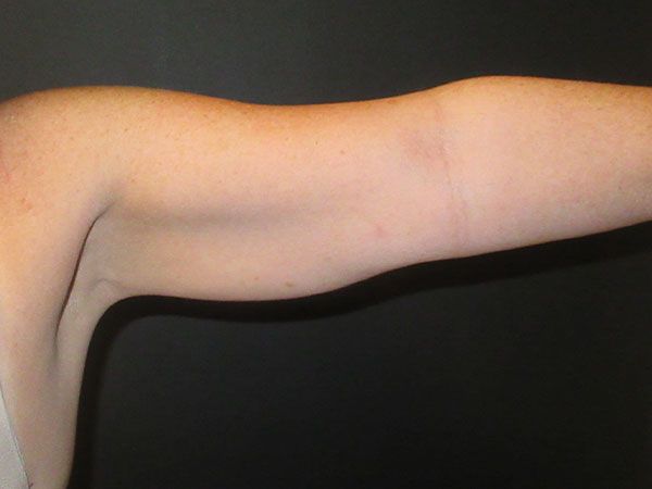 Emsculpt Neo Before & After