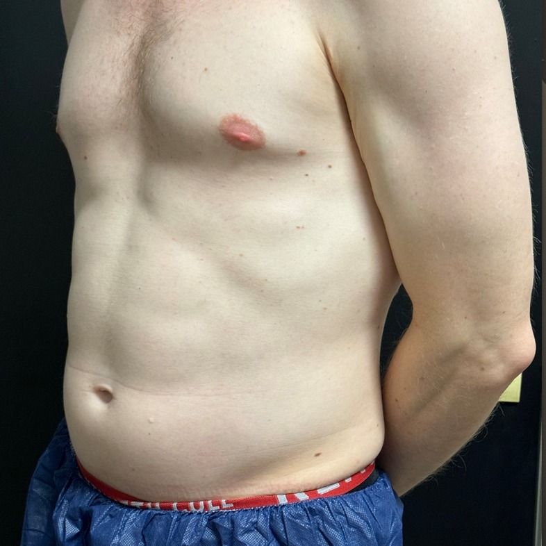 EMSCULPT NEO Before & After