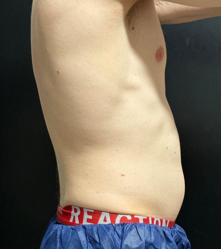 EMSCULPT NEO Before & After