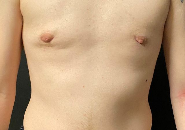 Top Surgery Before & After