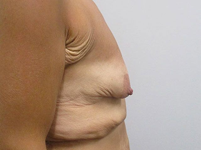 Breast Augmentation And Lift Before & After