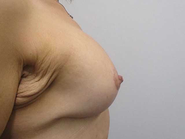 Breast Augmentation And Lift Before & After