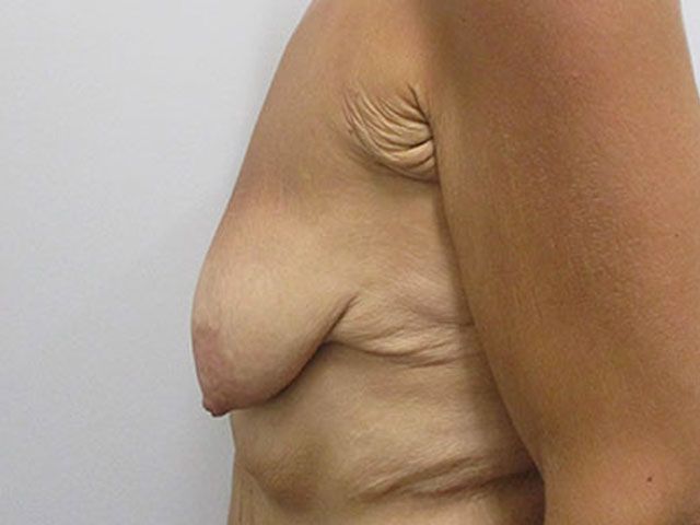 Breast Augmentation And Lift Before & After