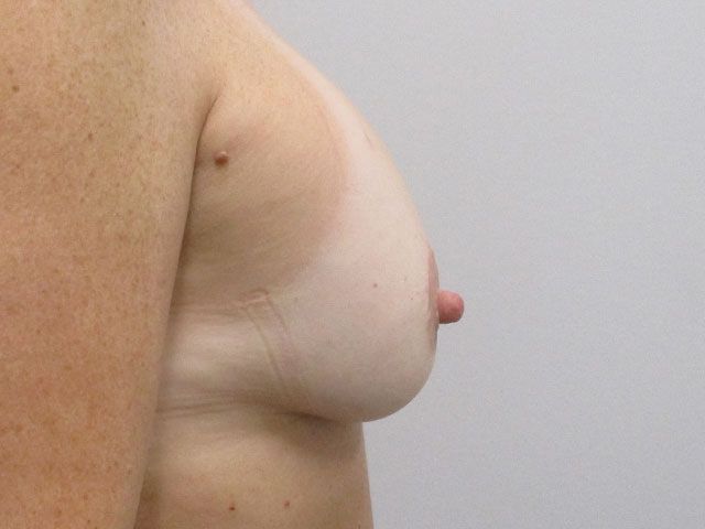Breast Augmentation And Lift Before & After