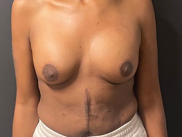 Breast Augmentation And Lift Before & After
