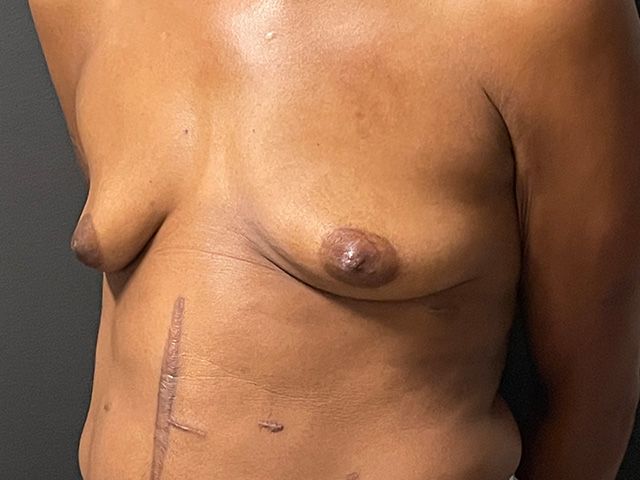 Breast Augmentation And Lift Before & After