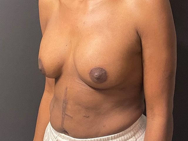 Breast Augmentation And Lift Before & After