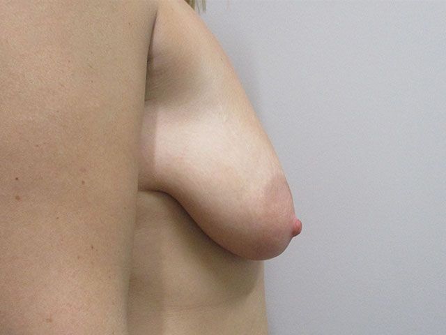Breast Augmentation And Lift Before & After