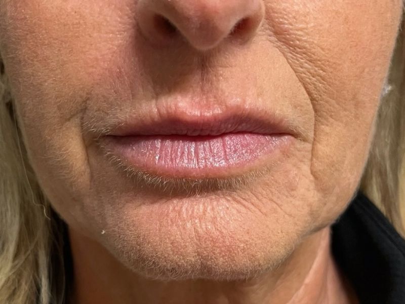 Hyperdilute Radiesse Before & After